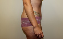 Tummy Tuck After Photo by Kyle Shaddix, MD; Pensacola, FL - Case 35995