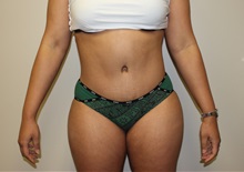 Tummy Tuck After Photo by Kyle Shaddix, MD; Pensacola, FL - Case 36008
