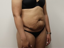 Tummy Tuck Before Photo by Kyle Shaddix, MD; Pensacola, FL - Case 36008
