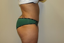 Tummy Tuck After Photo by Kyle Shaddix, MD; Pensacola, FL - Case 36008