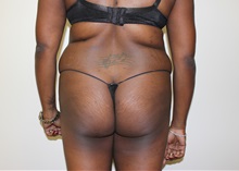 Buttock Lift with Augmentation Before Photo by Kyle Shaddix, MD; Pensacola, FL - Case 36089