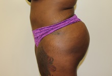 Buttock Lift with Augmentation After Photo by Kyle Shaddix, MD; Pensacola, FL - Case 36089