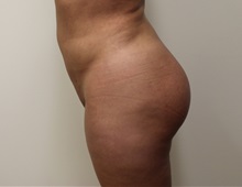 Buttock Lift with Augmentation After Photo by Kyle Shaddix, MD; Pensacola, FL - Case 36090