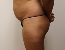 Buttock Lift with Augmentation Before Photo by Kyle Shaddix, MD; Pensacola, FL - Case 36090