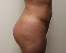 Buttock Lift with Augmentation After Photo by Kyle Shaddix, MD; Pensacola, FL - Case 36090