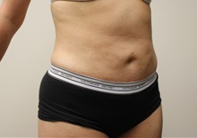 Liposuction After Photo by Kyle Shaddix, MD; Pensacola, FL - Case 36092
