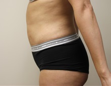 Liposuction After Photo by Kyle Shaddix, MD; Pensacola, FL - Case 36092