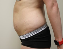 Liposuction Before Photo by Kyle Shaddix, MD; Pensacola, FL - Case 36092