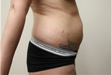 Liposuction Before Photo by Kyle Shaddix, MD; Pensacola, FL - Case 36092