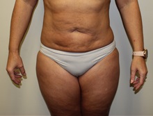 Liposuction After Photo by Kyle Shaddix, MD; Pensacola, FL - Case 36095
