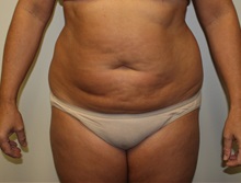 Liposuction Before Photo by Kyle Shaddix, MD; Pensacola, FL - Case 36095
