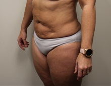Liposuction After Photo by Kyle Shaddix, MD; Pensacola, FL - Case 36095