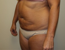 Liposuction Before Photo by Kyle Shaddix, MD; Pensacola, FL - Case 36095