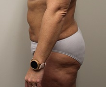 Liposuction After Photo by Kyle Shaddix, MD; Pensacola, FL - Case 36095