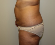 Liposuction Before Photo by Kyle Shaddix, MD; Pensacola, FL - Case 36095