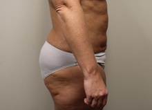 Liposuction After Photo by Kyle Shaddix, MD; Pensacola, FL - Case 36095