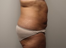 Liposuction Before Photo by Kyle Shaddix, MD; Pensacola, FL - Case 36095