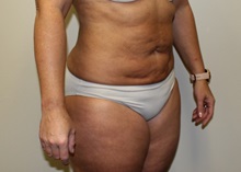 Liposuction After Photo by Kyle Shaddix, MD; Pensacola, FL - Case 36095