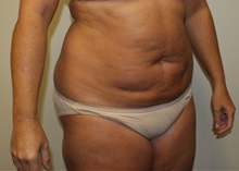 Liposuction Before Photo by Kyle Shaddix, MD; Pensacola, FL - Case 36095