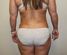 Liposuction After Photo by Kyle Shaddix, MD; Pensacola, FL - Case 36095