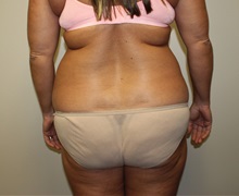 Liposuction Before Photo by Kyle Shaddix, MD; Pensacola, FL - Case 36095