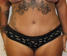 Tummy Tuck After Photo by Kyle Shaddix, MD; Pensacola, FL - Case 36229