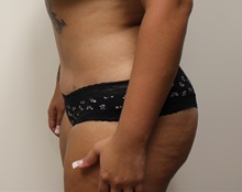 Tummy Tuck After Photo by Kyle Shaddix, MD; Pensacola, FL - Case 36229