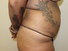 Tummy Tuck Before Photo by Kyle Shaddix, MD; Pensacola, FL - Case 36229