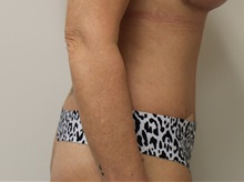 Tummy Tuck After Photo by Kyle Shaddix, MD; Pensacola, FL - Case 36230