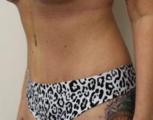 Tummy Tuck After Photo by Kyle Shaddix, MD; Pensacola, FL - Case 36230
