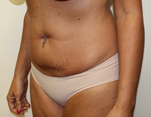 Tummy Tuck Before Photo by Kyle Shaddix, MD; Pensacola, FL - Case 36230
