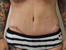 Tummy Tuck After Photo by Kyle Shaddix, MD; ,  - Case 36240