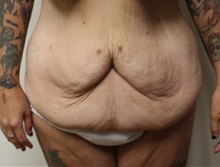 Tummy Tuck Before Photo by Kyle Shaddix, MD; ,  - Case 36240