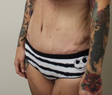 Tummy Tuck After Photo by Kyle Shaddix, MD; ,  - Case 36240