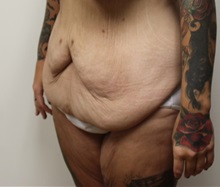 Tummy Tuck Before Photo by Kyle Shaddix, MD; ,  - Case 36240