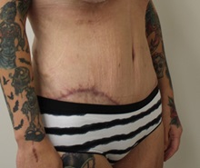 Tummy Tuck After Photo by Kyle Shaddix, MD; ,  - Case 36240