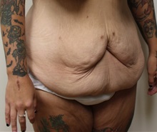 Tummy Tuck Before Photo by Kyle Shaddix, MD; ,  - Case 36240