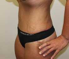 Tummy Tuck After Photo by Kyle Shaddix, MD; Pensacola, FL - Case 36241