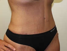 Tummy Tuck After Photo by Kyle Shaddix, MD; Pensacola, FL - Case 36241