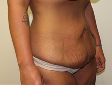 Tummy Tuck Before Photo by Kyle Shaddix, MD; Pensacola, FL - Case 36241