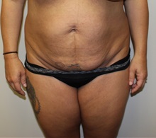 Tummy Tuck Before Photo by Kyle Shaddix, MD; Pensacola, FL - Case 36242