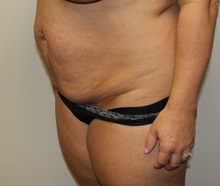 Tummy Tuck Before Photo by Kyle Shaddix, MD; Pensacola, FL - Case 36242