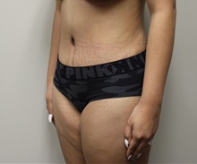 Tummy Tuck After Photo by Kyle Shaddix, MD; Pensacola, FL - Case 36243