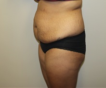 Tummy Tuck Before Photo by Kyle Shaddix, MD; Pensacola, FL - Case 36243