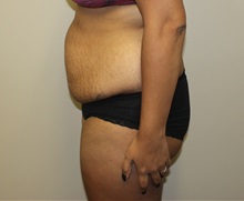 Tummy Tuck Before Photo by Kyle Shaddix, MD; Pensacola, FL - Case 36243