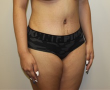 Tummy Tuck After Photo by Kyle Shaddix, MD; Pensacola, FL - Case 36243