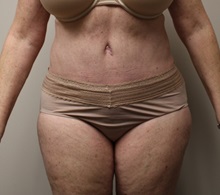 Tummy Tuck After Photo by Kyle Shaddix, MD; Pensacola, FL - Case 36245