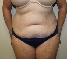 Tummy Tuck Before Photo by Kyle Shaddix, MD; Pensacola, FL - Case 36245