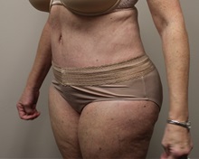 Tummy Tuck After Photo by Kyle Shaddix, MD; Pensacola, FL - Case 36245