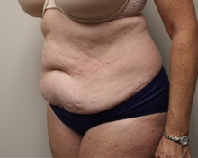 Tummy Tuck Before Photo by Kyle Shaddix, MD; Pensacola, FL - Case 36245